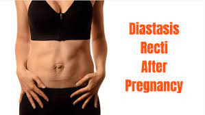 Exactly How to Cure Diastasis Recti without Pregnancy.